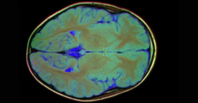 Brain MRI Cost in Kanpur